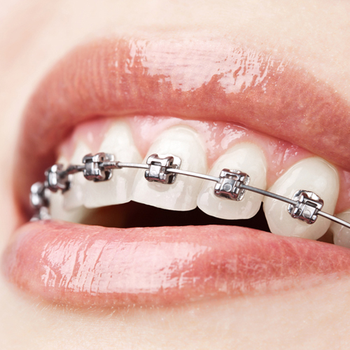 Traditional Braces Orthodontic Treatment In Port Macquarie Port