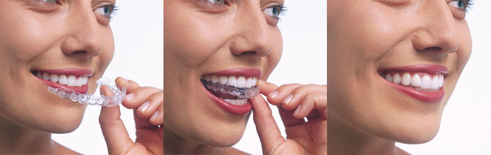 Invisalign