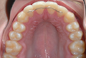Orthodontic treatment after