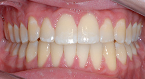 Orthodontic treatment after