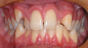 Orthodontic treatment before