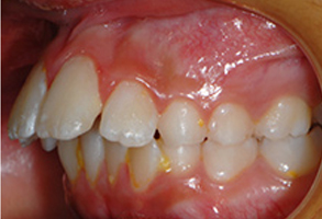 Orthodontic treatment before