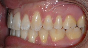 Orthodontic treatment after