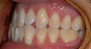 Orthodontic treatment before